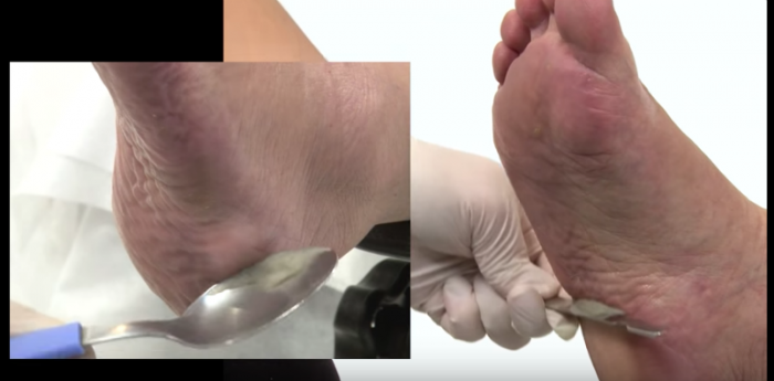 Remoção das células mortas com espátula