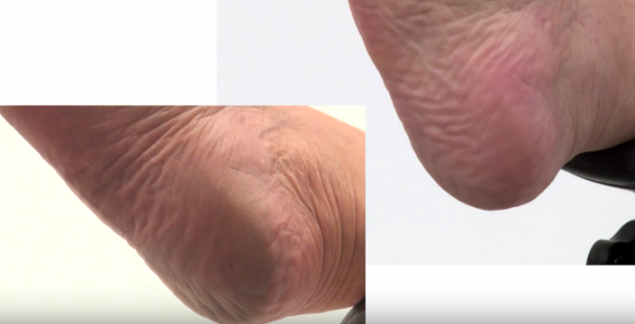 Demonstração de antes e depois da remoção de calos.